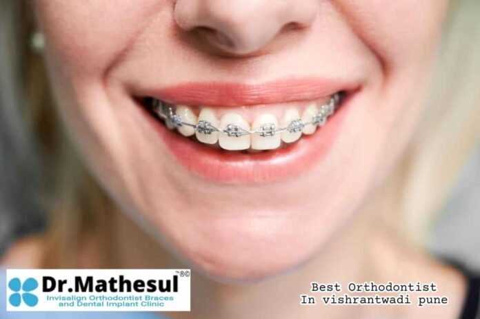Invisalign treatment Pune, Clear aligners Vishrantwadi, Dr. Mathesul dental clinic, Best dentist in Kalyani Nagar, Braces specialist East Pune, Dental implants Pune, Orthodontic clinic near me, Ceramic and metal braces Pune, Smile makeover Vishrantwadi, Expert orthodontist in Pune,Best Orthodontist in Vishrantwadi Pune